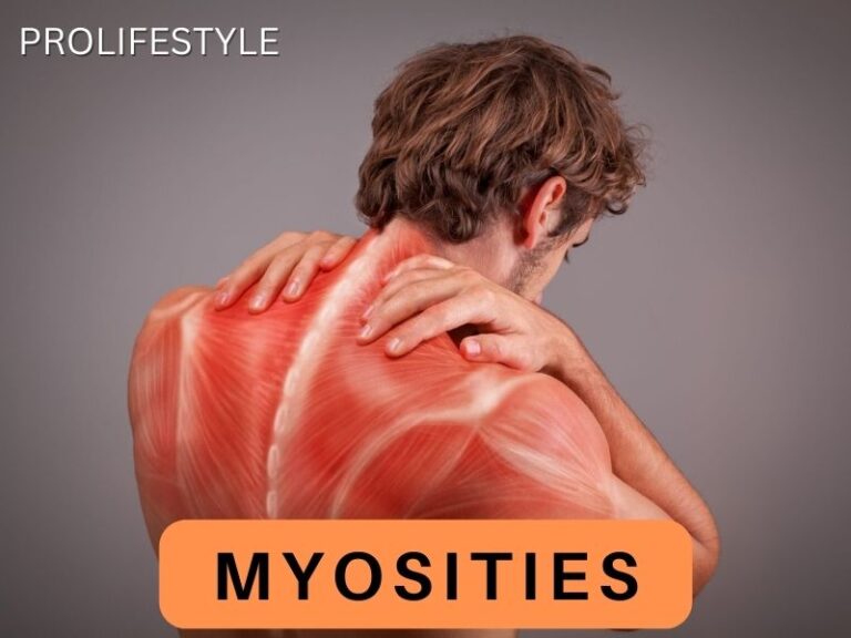 Myositis : Symptom, Cause, Cure & Side Effect ‣ Prolifestyle