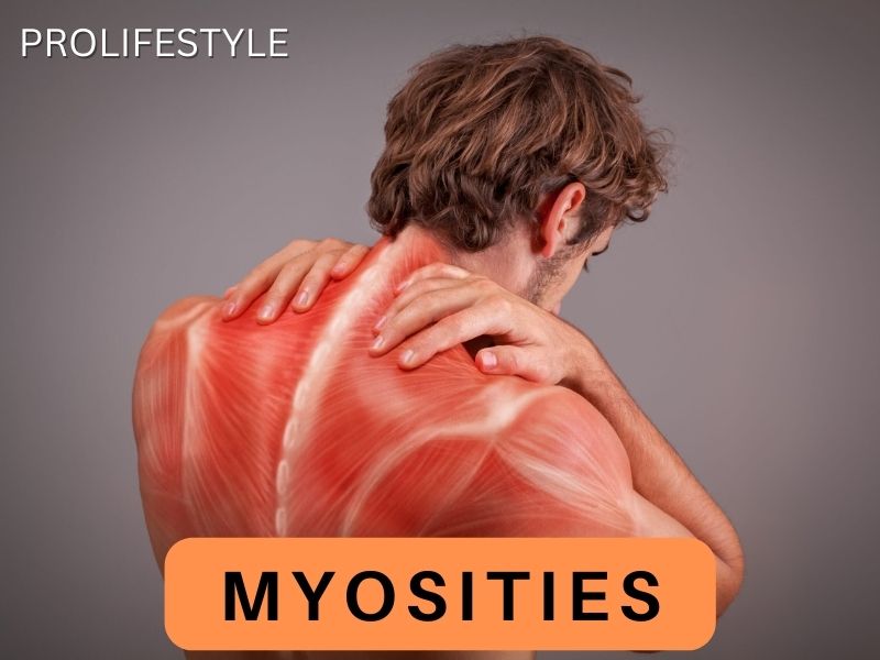 Myositis : symptom, cause, cure & side effect