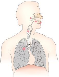 respiratory, typhoid symptom, prolifestyle, lifetsyle