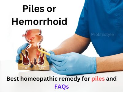 piles or hemorrhoid, best medicine for the piles, pro lifestyle, prolifestyle homeopathic medicine for piles or hemorrhoid