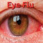 pink eye, eye flu, conjunctivitis, eye disease, symptoms of eye disease, eye flu symptoms, prolifestyle eye flu, pink eye prolifestyle