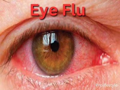 Red eye flu : Symptoms, cause, cure and FAQs