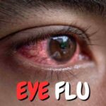 Eye Flu fastest way to cure eye flu, faqs of eye flu, what is the fastest way to eye flu, prolifestyle tips on eye flu, pro lifestyle, eye flu prolifestyle
