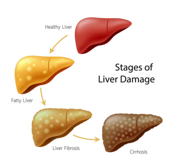 liver health problem,, pdf on what to eat while ill liver by prolifestyle, ebook pdf, prolifestyle.in ebooks